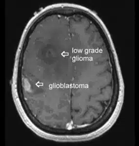 glioma