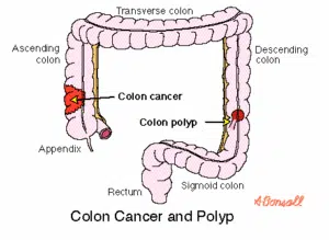 Colon Cancer and Polyp resized 600