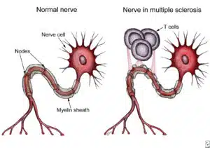 Multiple sclerosis T cells