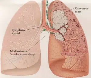 Non Small cell Lung Cancer resized 600