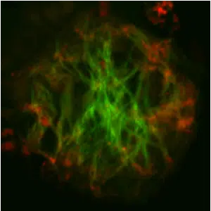 amyloid