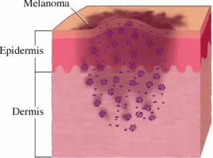 melanoma resized 600