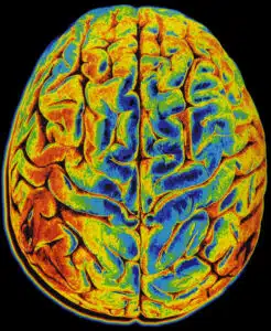 NEW IMAGING TECHNIQUE DISTIGUISHES TUMORS FROM NORMAL TISSUE 1 brain.scan_