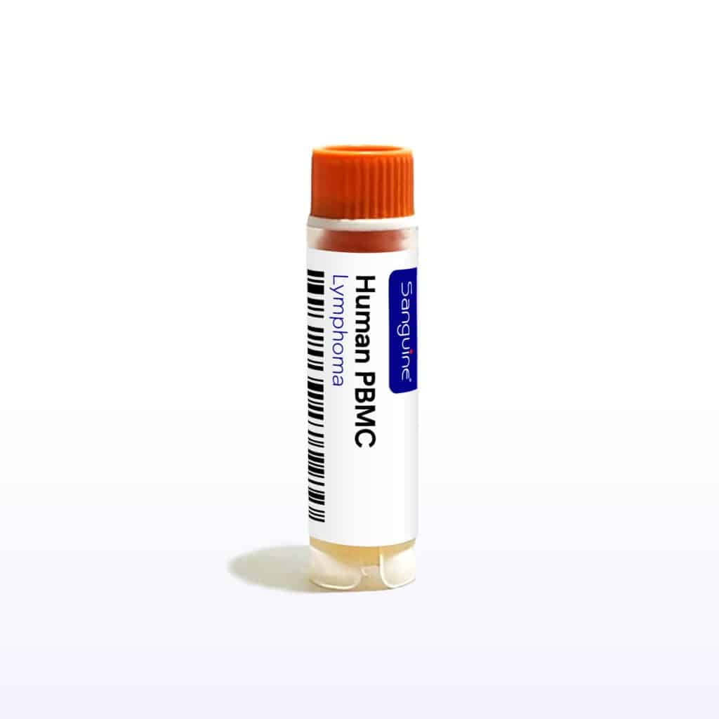 Lymphoma PBMC