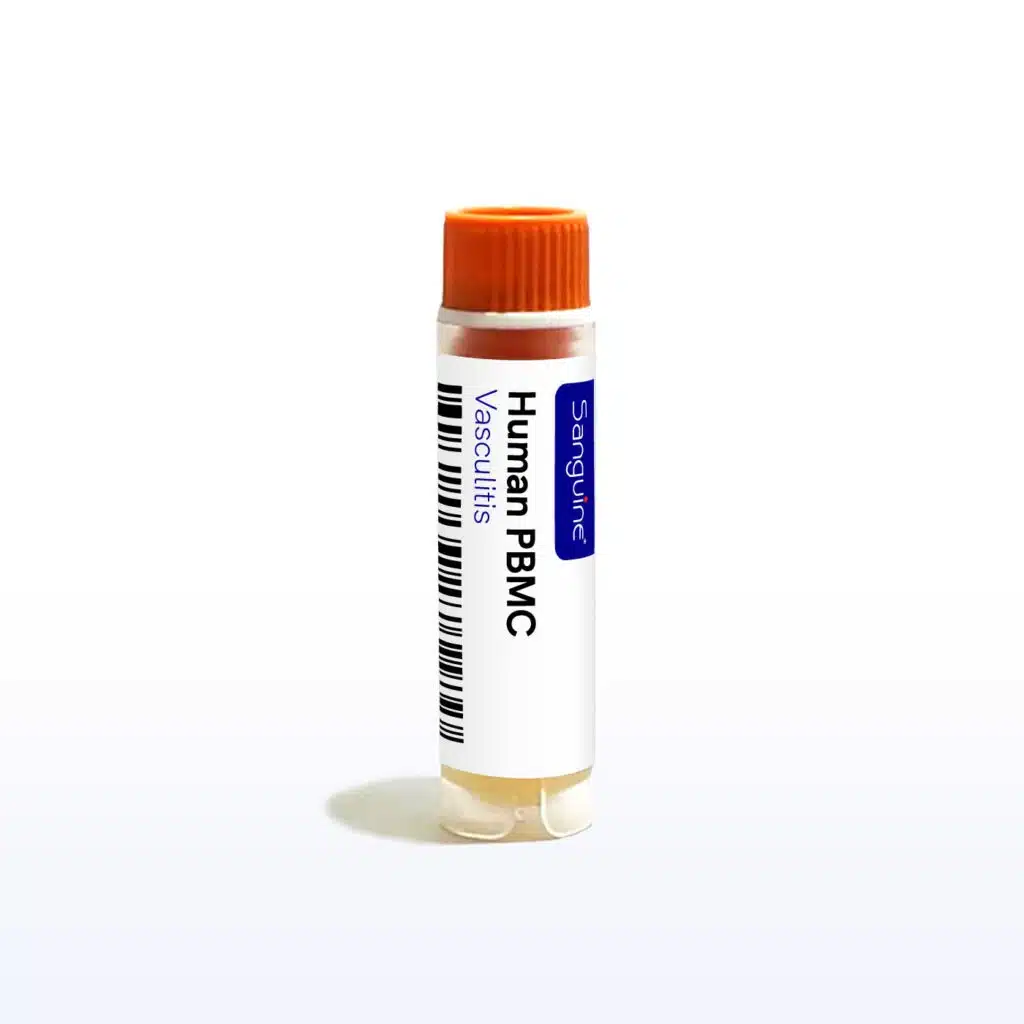 Vasculitis PBMC