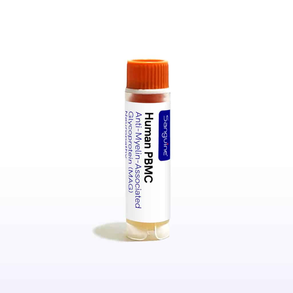 Anti-MAG Neuropathy PBMC