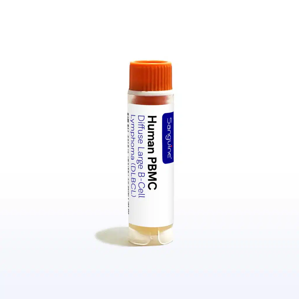 Diffuse Large B-Cell Lymphoma PBMC
