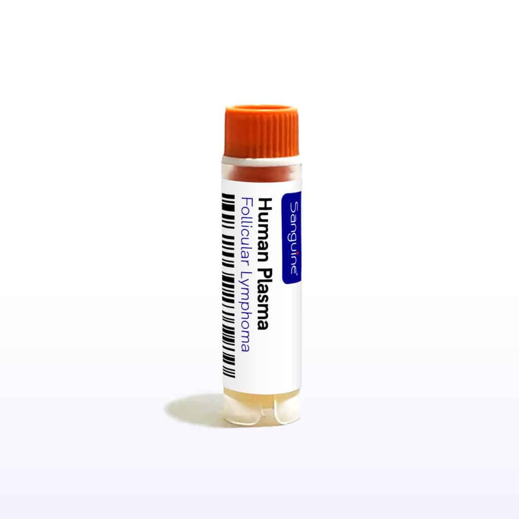 Follicular Lymphoma Plasma