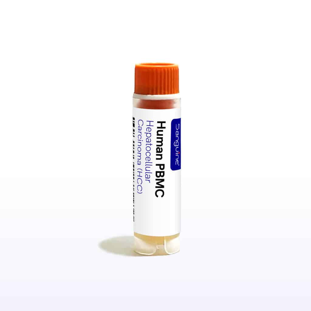 Hepatocellular Carcinoma PBMC