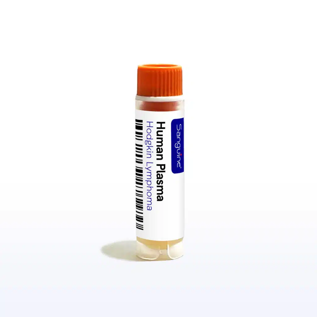 Hodgkin Lymphoma Plasma