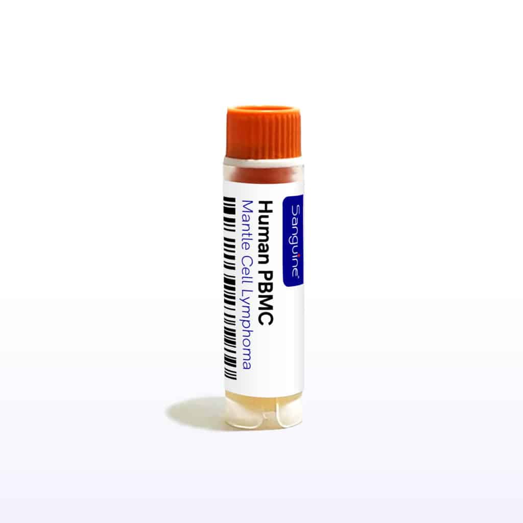 Mantle Cell Lymphoma PBMC