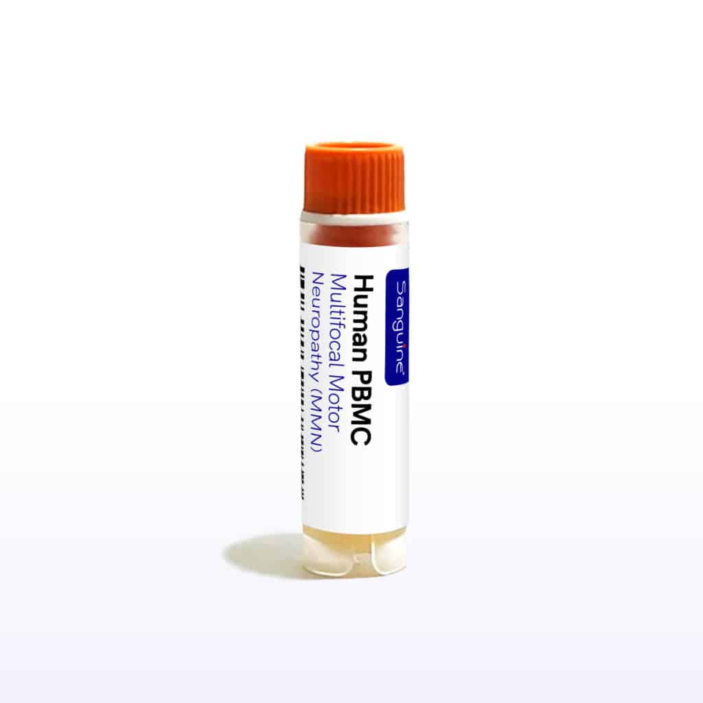 Multifocal Motor Neuropathy PBMC