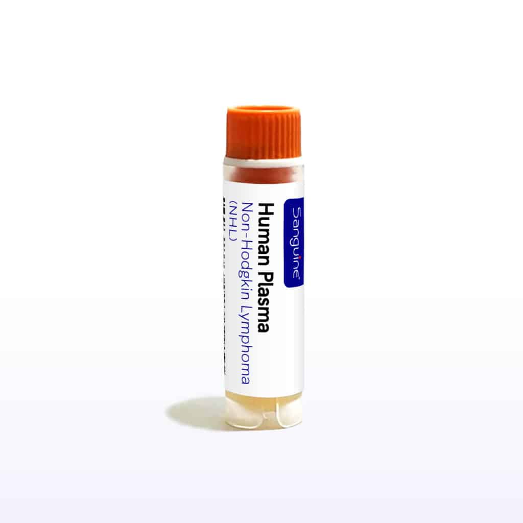 Non-Hodgkin Lymphoma Plasma