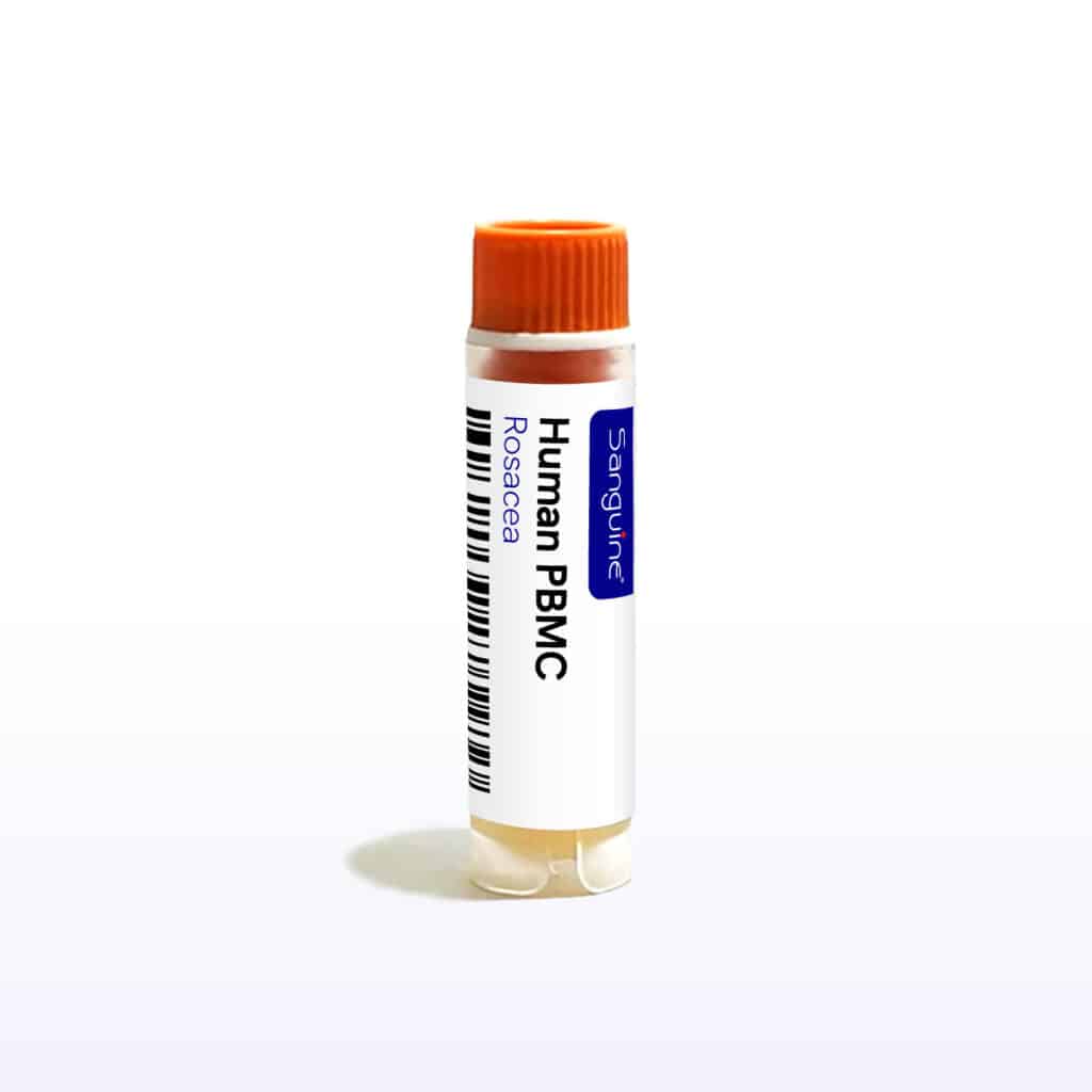 Rosacea PBMC