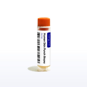 Acne Skin Punch Biopsy