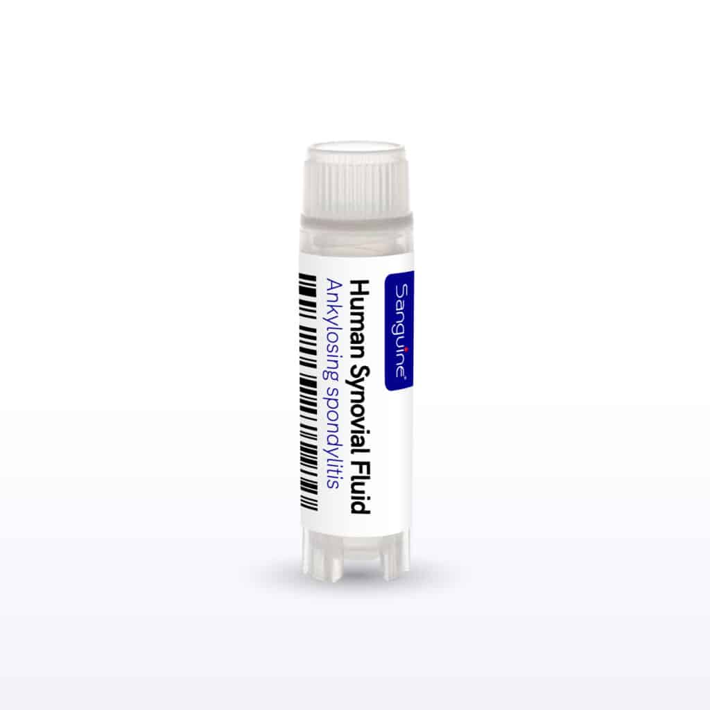 Ankylosing Spondylitis Synovial Fluid