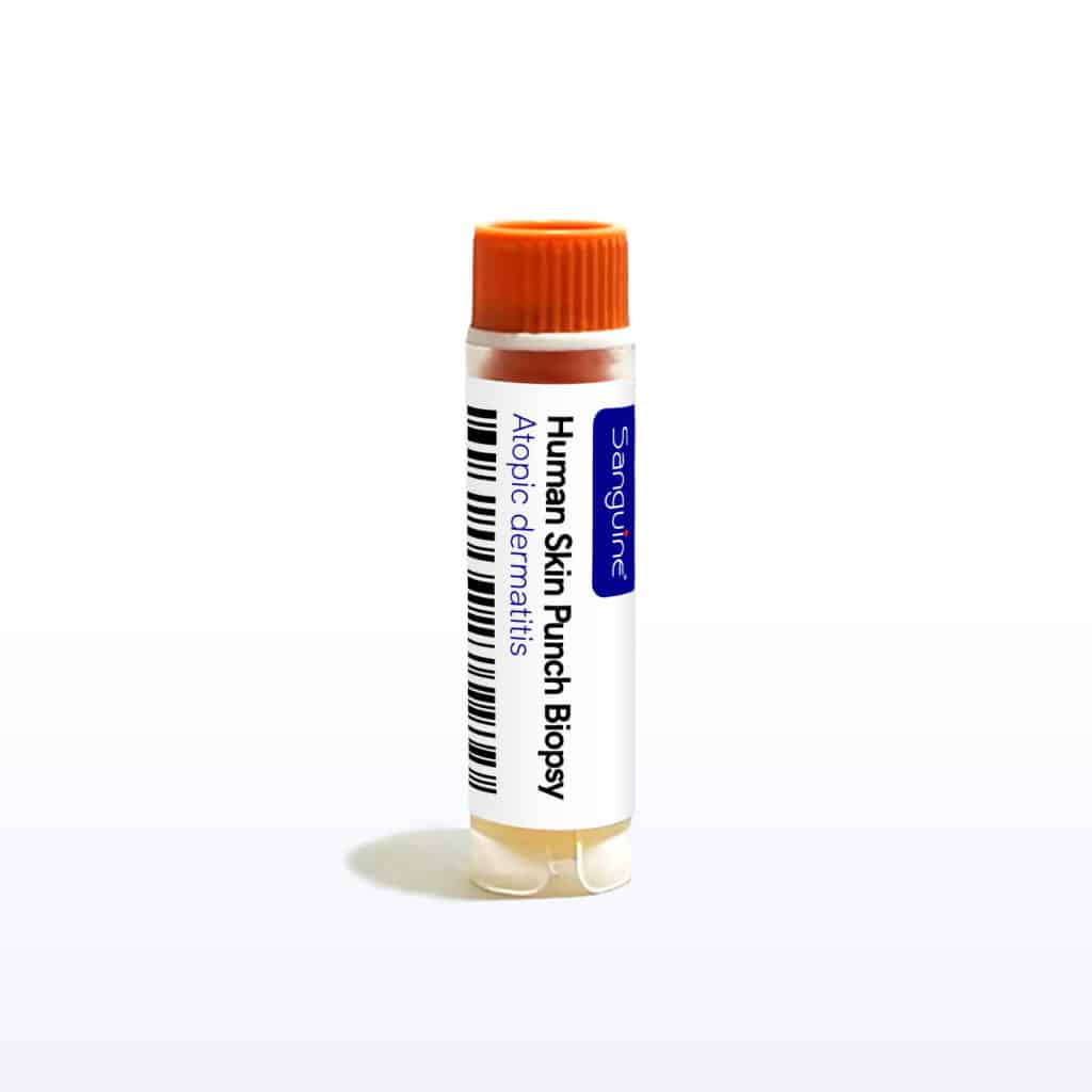 Atopic Dermatitis Skin Punch Biopsy