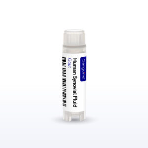 Gout Synovial Fluid