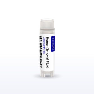 Osteoarthritis Synovial Fluid