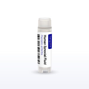 Psoriatic Arthritis Synovial Fluid