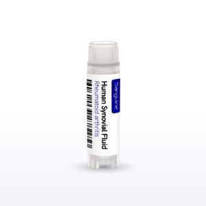 Rheumatoid Arthritis Synovial Fluid