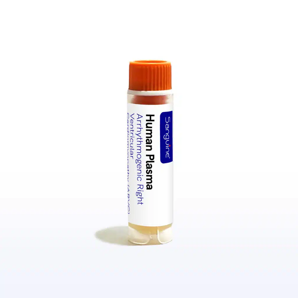 Arrhythmogenic Right Ventricular Cardiomyopathy ARVC Plasma