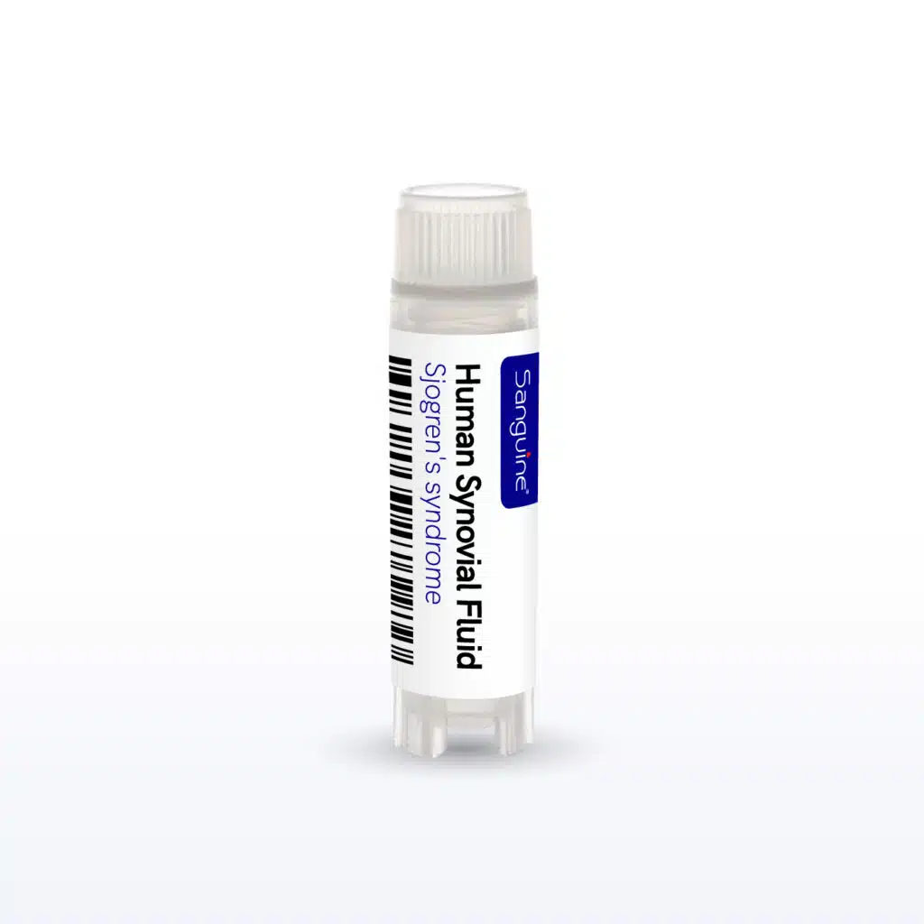 Sjogren’s Syndrome Synovial Fluid