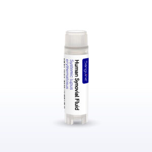 Systemic Lupus Erythamatosus Synovial Fluid