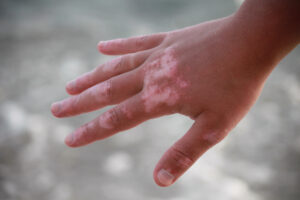 Vitiligo for skin punch biopsy
