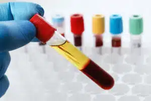 Serum vs Plasma: Choosing the Right Biospecimen for Your Research 1 Serum vs plasma biospecimen comparison