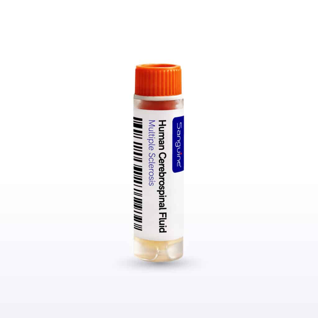 Multiple Sclerosis Cerebrospinal Fluid