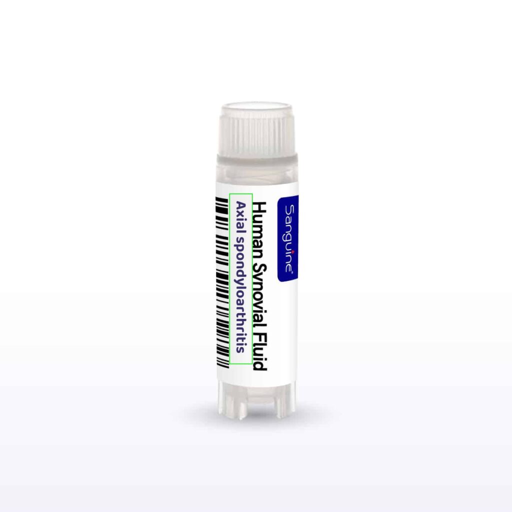 Axial Spondyloarthritis Synovial Fluid