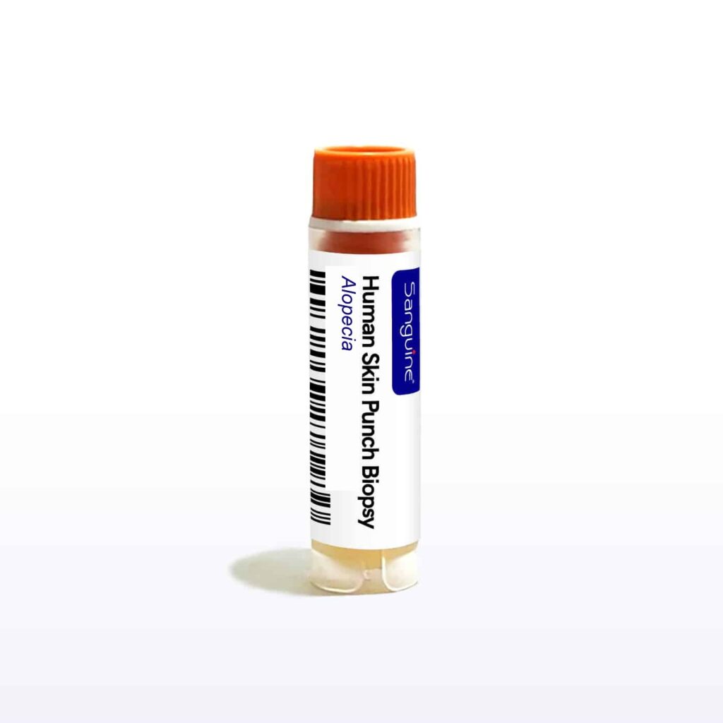 Alopecia Skin Punch Biopsy