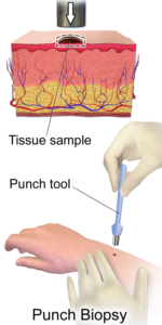 skin punch biopsy diagram