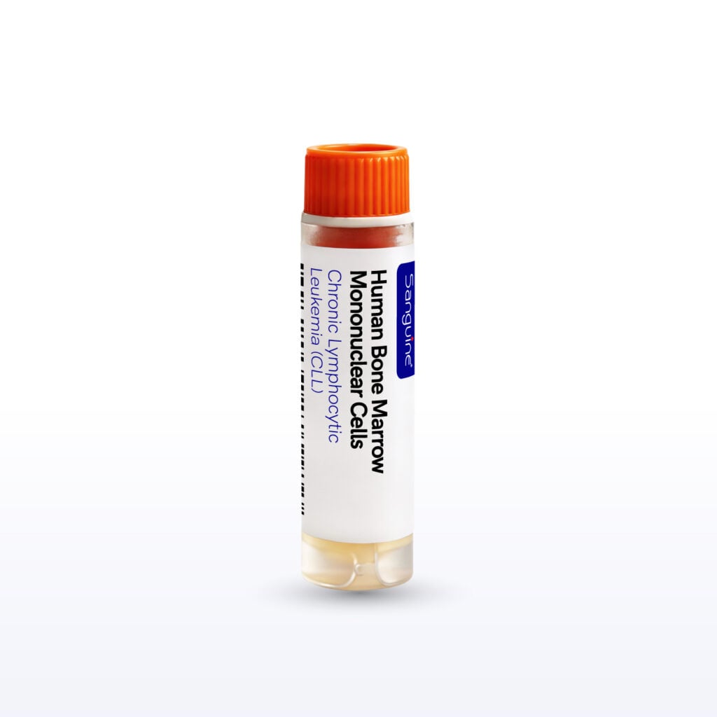 Chronic Lymphocytic Leukemia (CLL) Bone Marrow Mononuclear Cells